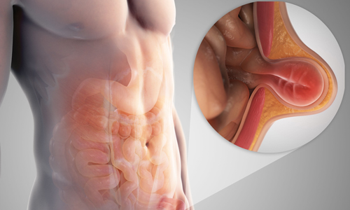 Hernia Surgery