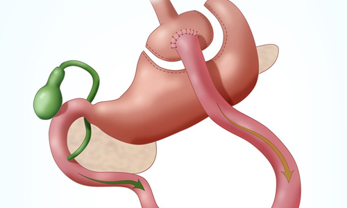 Gastric Bypass (Stomach Bypass Surgery)
