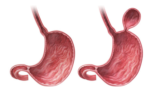 Hiatal Hernia Surgery