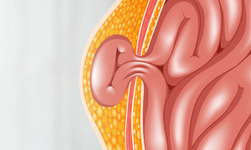 Abdominal Hernia Surgery