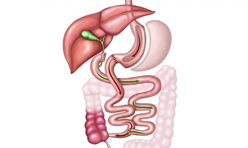 SADI-S Surgery